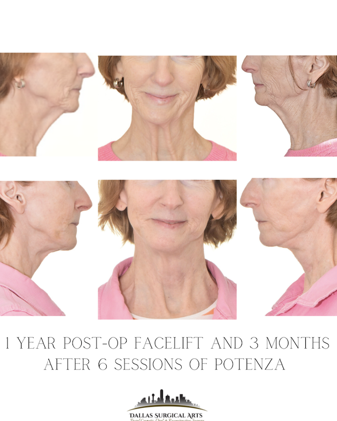 Non-Surgical Facelift Rejuvenation: Potenza RF and PDO Thread Lift